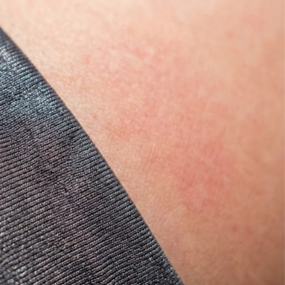 It started with a rash